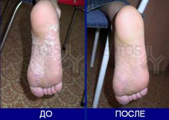 Тимодепрессин Тимодепрессин